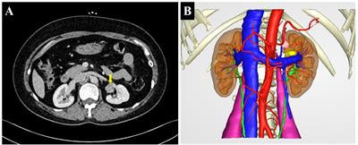 Case report: An ectopic adrenocortical adenoma in the renal sinus